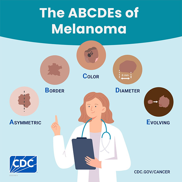Infographic from the CDC titled "The ABCDEs of Melanoma." An illustration of a doctor points to five visual examples of mole characteristics to look out for: Asymmetric, Border, Color, Diameter, and Evolving.